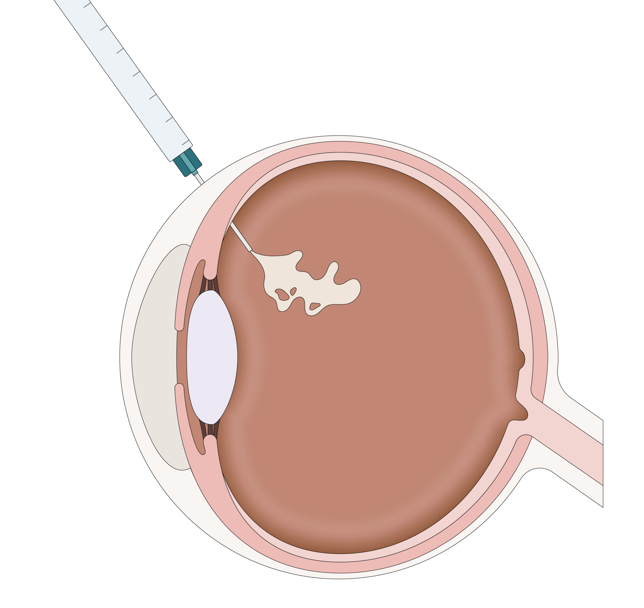 Post Intravitreal Injection Retinal Treatments – PVSC